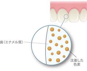 オフィスホワイトニング